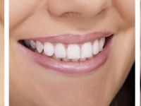 (P) Cât trebuie să scoți din buzunar pentru un implant dentar și cât de mult își merită banii?